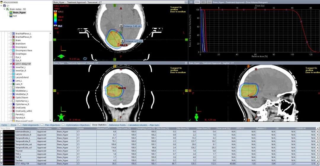 HyperArc_clinical_treatment_in_TrueBeam