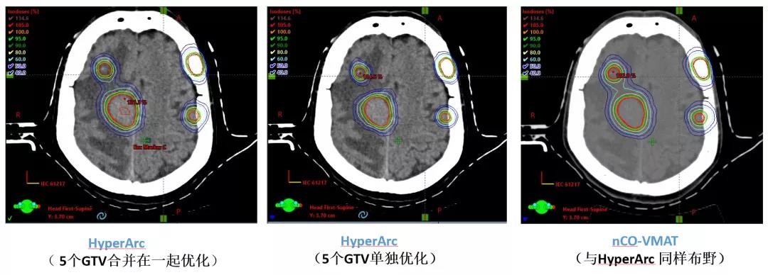 HyperArc_clinical_treatment_in_TrueBeam