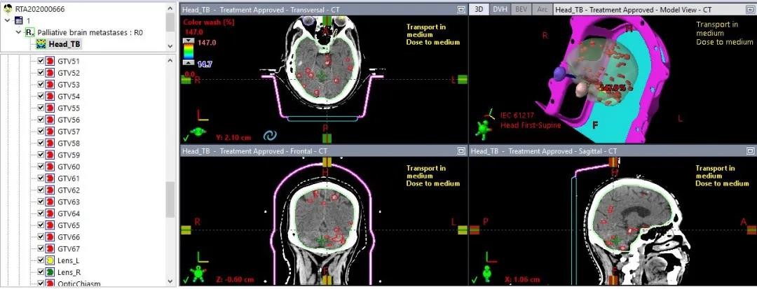 HyperArc clinical treatment in TrueBeam