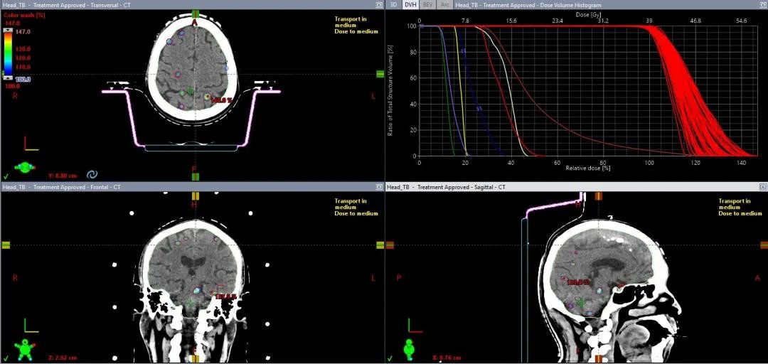 HyperArc clinical treatment in TrueBeam