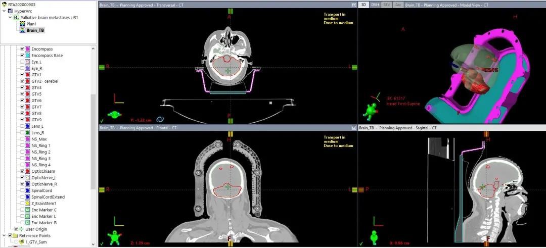 HyperArc clinical treatment in TrueBeam