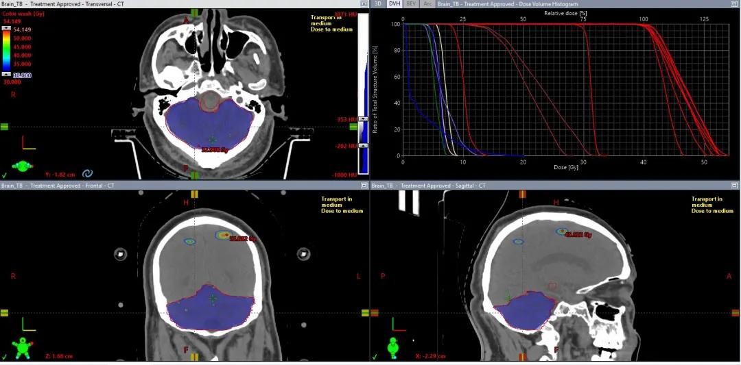 HyperArc clinical treatment in TrueBeam