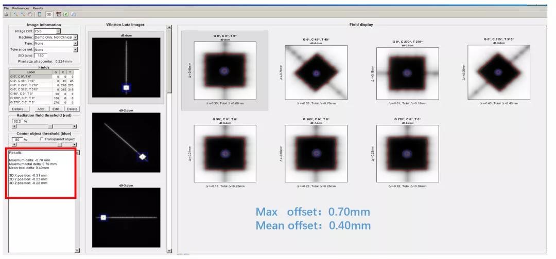 HyperArc clinical treatment in TrueBeam