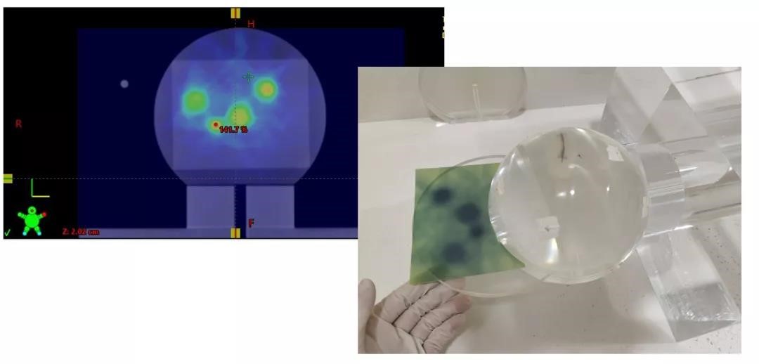 HyperArc clinical treatment in TrueBeam